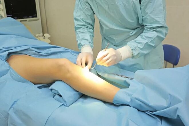 Fleebectomy
