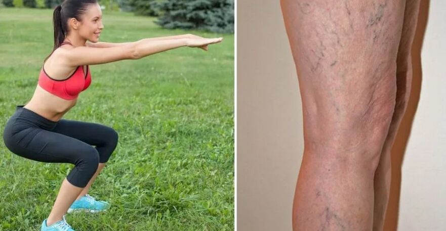 Foot for varicose veins