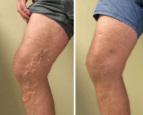 Venous veins before and after treatment