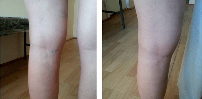 intravenous veins on the legs