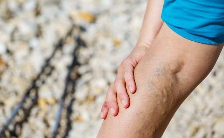 Intravenous veins on the legs